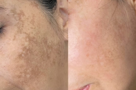 PEELING.png