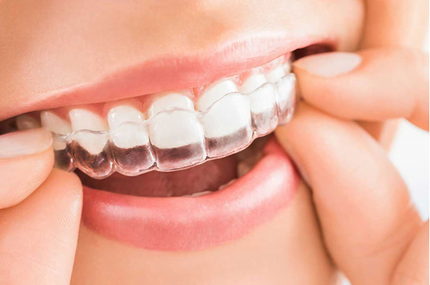 invisalign-alinhador-transparente-aparelho-florianopolis.png
